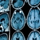 Alzheimer : un nouveau médicament expérimental pour prévenir la maladie